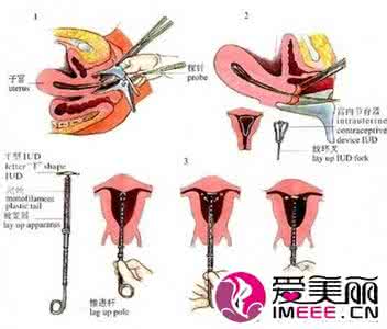 带环后注意事项 带环后注意事项 女性如何节育