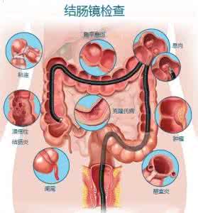 乙状结肠癌根治术图解 图解：早期发现结肠癌