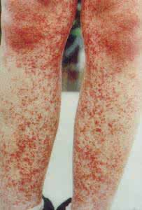 男性尖锐湿疹患者治疗 得了尖锐湿疹怎么办 患者的饮食禁忌是怎样