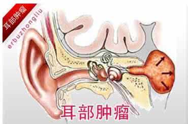 中耳炎到中耳癌的时间 中耳癌 导致中耳癌的原因有哪些