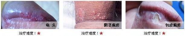 阴茎疱疹的治疗方法 湿疣疱疹的治疗方法