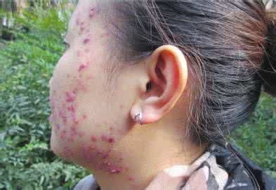 美容院脸部排毒真相 女子使用美容院推荐的新产品 脸部又红又痒