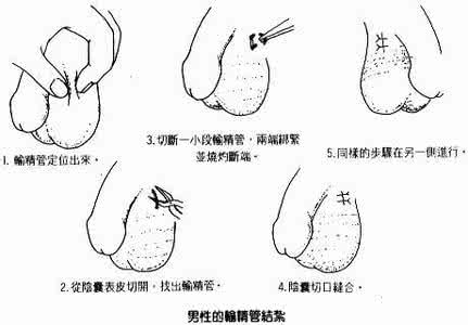 男性避孕手术 男性做避孕手术的具体步骤详解