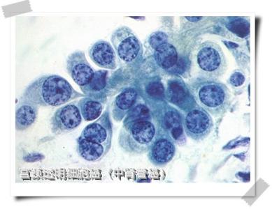 显微镜下的癌细胞 显微镜下的各种癌细胞形状