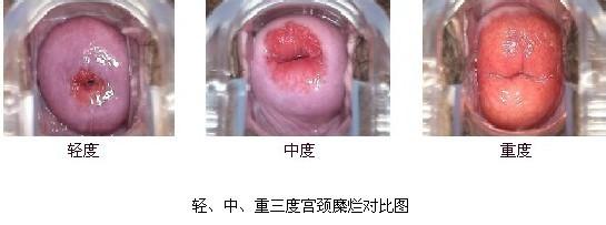 重度宫颈糜烂好治疗吗 宫颈糜烂二度多怎么治疗？能治好吗？