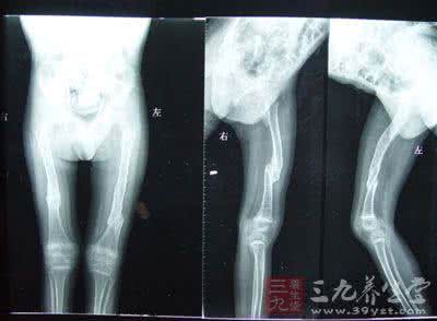 摔了一跤 怪病40年没查出病因 摔一跤竟查出是罕见病