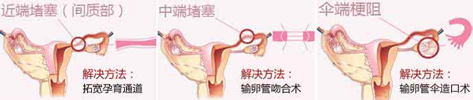 如何预防输卵管堵塞 1如何预防输卵管堵塞 预防输卵管堵塞的5种常识