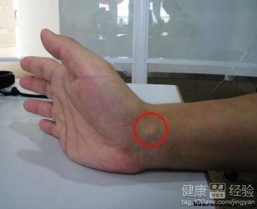 腱鞘囊肿不治疗会怎样 腱鞘囊肿怎样治疗