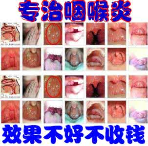 慢性咽炎的治疗方法 慢性咽炎的治疗方法集合