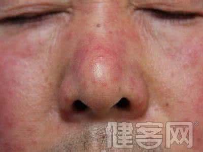 酒渣鼻与酒糟鼻区别 酒渣鼻怎么引起的 如何治疗酒糟鼻