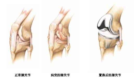 怎么样治疗骨性关节炎 骨性关节炎的治疗 骨性关节炎怎么治疗最有效