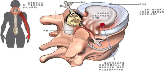 椎动脉型颈椎病严重吗 椎动脉型颈椎病严重吗 颈椎病的10个级别----赶紧来自查 严重者手术风险极高