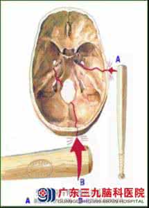颅底骨折的临床表现 颅底骨折的临床表现 骨折的临床表现与症状