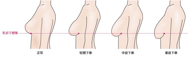 预防乳房下垂 预防乳房下垂有三招