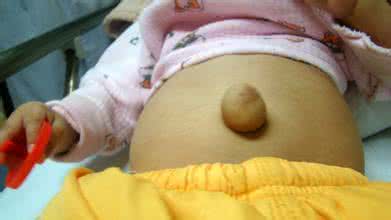 中药疝气袋脐疝袋疗法 肚脐疝气中药良方无需手术