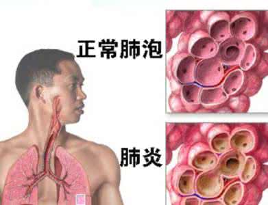 衣原体感染的症状女性 衣原体感染的症状
