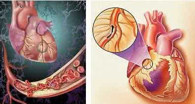 冠心病 血栓 警惕冠心病“大敌”——“动脉血栓”