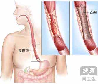 食管癌早期症状 食管癌早期症状 食管癌有哪些早期症状