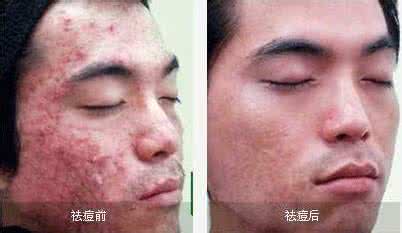 治疗面部痤疮疤痕 不传秘方: 面部痤疮十余年百治百愈浙贝母汤