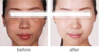 激光祛斑黄褐斑 激光祛斑会反弹吗 如何去除脸上黄褐斑