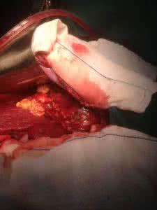 肿瘤破裂出血 肿瘤破裂出血 身体这些地方出血当心是肿瘤！