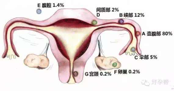 什么情况容易宫外孕 哪些人容易得宫外孕 容易引起宫外孕的功能性因素