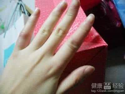 中医秘方绝技大公开 秘冻疮秘方,大公开,一次治愈,送给北方的朋友!