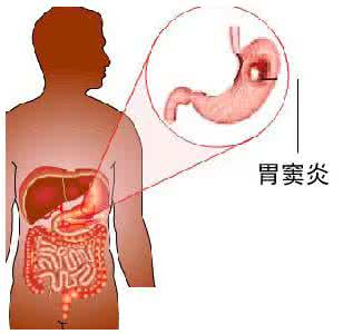 糜烂性胃窦炎症状 胃窦炎的症状