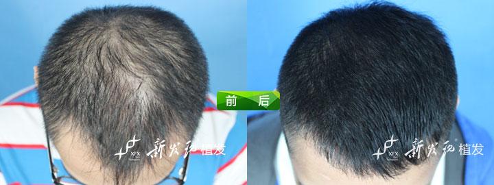 治疗脱发的最好方法 治疗脱发的最好方法 不同治疗脱发的方法