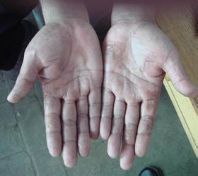 手癣脚癣的治疗方法 手癣脚癣的治疗方法 手癣脚癣怎么治？