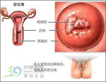 宫颈癌前病变的图片 宫颈癌前病变 宫颈癌前病变是怎么样的