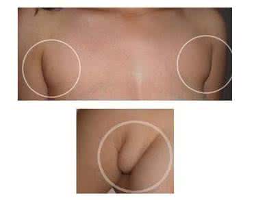 乳房下垂副乳 副乳疼 如何正确呵护乳房健康