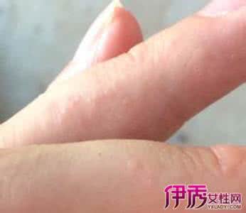 手指上起小水泡 当手指上起了水泡的时候 我们该怎么办?
