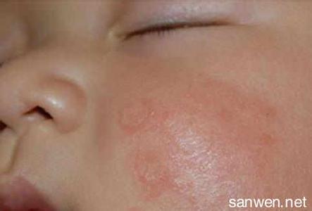 脸上长白癣怎么治 脸上长癣能治好吗?