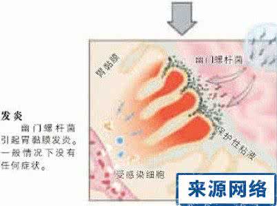 怎样才能治好胃病 根除幽门螺杆菌，胃病才能不复发。