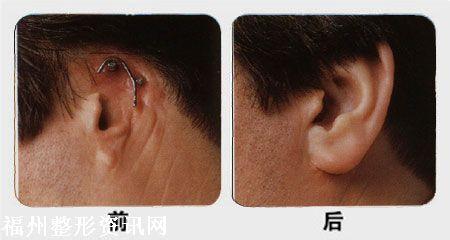 全耳再造 耳再造 全耳再造