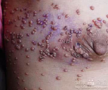 小姐是不是都有艾滋病 肛交后是不是一定会得艾滋病