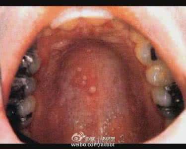 疱疹性咽峡炎手足口病 幼儿园疱疹性咽峡炎大爆发！比手足口病还厉害？