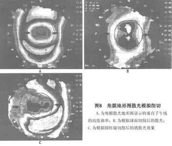 如何治疗散光 散光怎么办 如何治疗散光