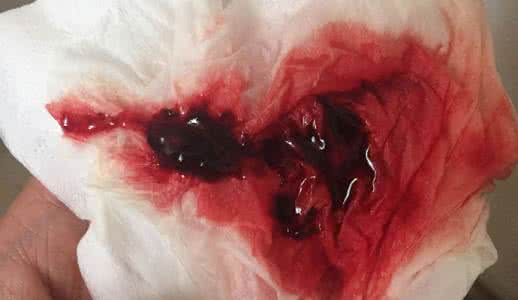 来月经有血块怎么调理 来月经有血块 来月经有血块的调理方法