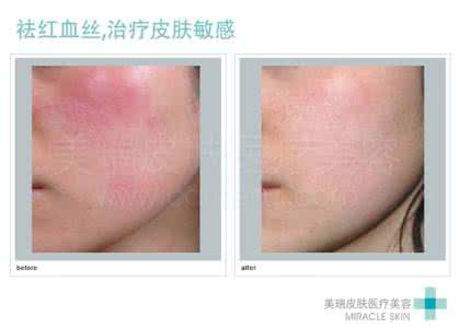 面部红血丝产生原因 面部红血丝产生原因 面部红血丝的形成原因让分析