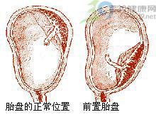 孕早期腰疼流产征兆 孕早期流血是怎么回事 孕早期阴道流血就一定是流产的征兆吗?