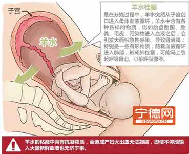 产妇羊水栓塞 孕期注意：五类产妇须留意羊水栓塞