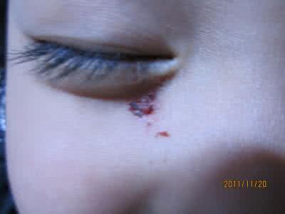 脸部烫伤后怎么处理 小伙遭人热汤泼脸烫伤 脸部皮开肉绽