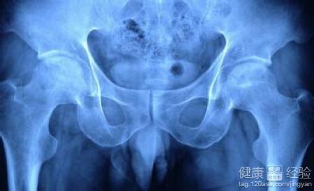 股骨头坏死公开的秘方 ?股骨头坏死特效秘方,速速扩散,治病救人,功德无量。