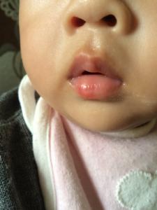 宝宝嘴唇磕破肿了 嘴唇破了肿了什么原因?