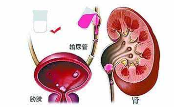 肾积水的治疗方法 肾积水的治疗方法 肾积水一定能治疗好吗？