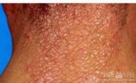 皮肤瘙痒防治 皮肤瘙痒的防治