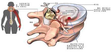 神经根型颈椎病治疗法 神经根型颈椎病治疗法 颈椎病的中药拔罐治疗法