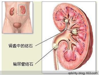 肾结石祖传秘方特效药 治疗肾结石的特效秘验方法